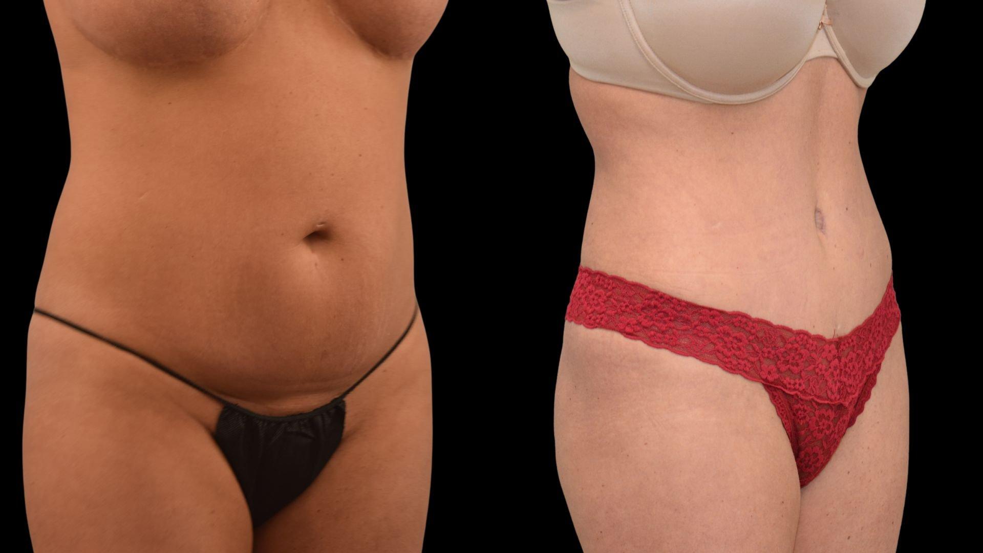 The Plastics Atelier tummy tuck result — Omaha, NE