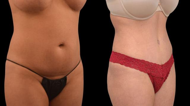 Tummy Tuck result at The Plastics Atelier in Omaha, NE