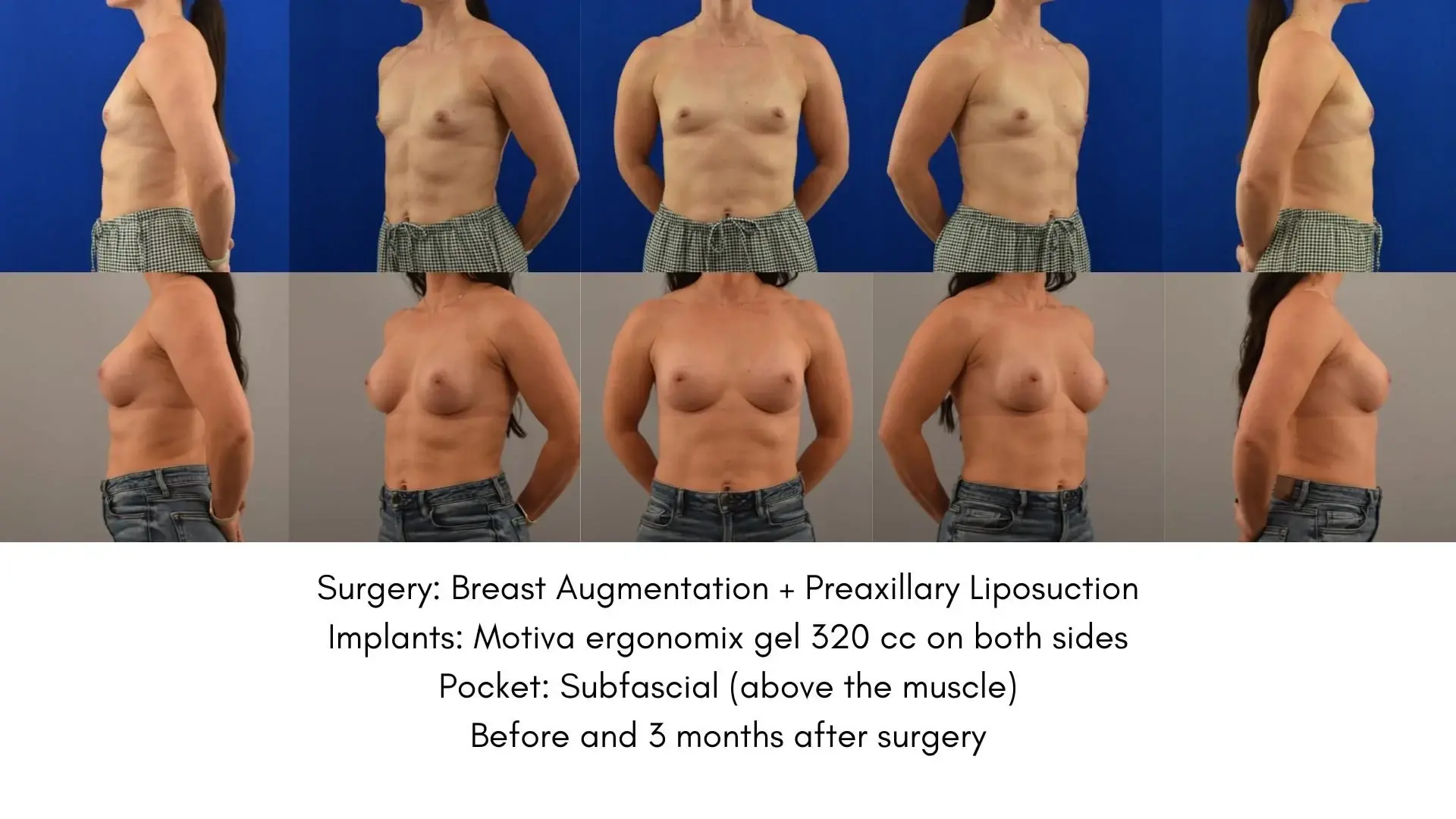 The Plastics Atelier breast augmentation result — Omaha, NE