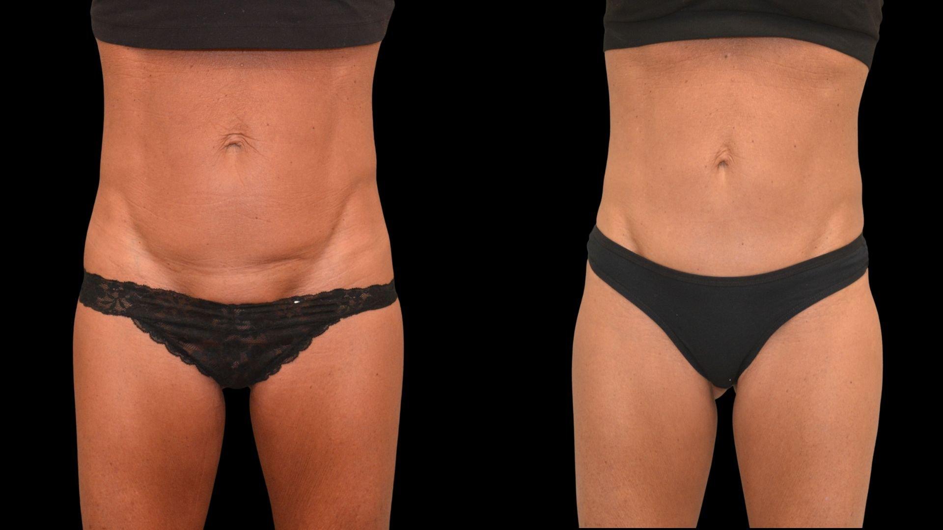 The Plastics Atelier tummy tuck result — Omaha, NE