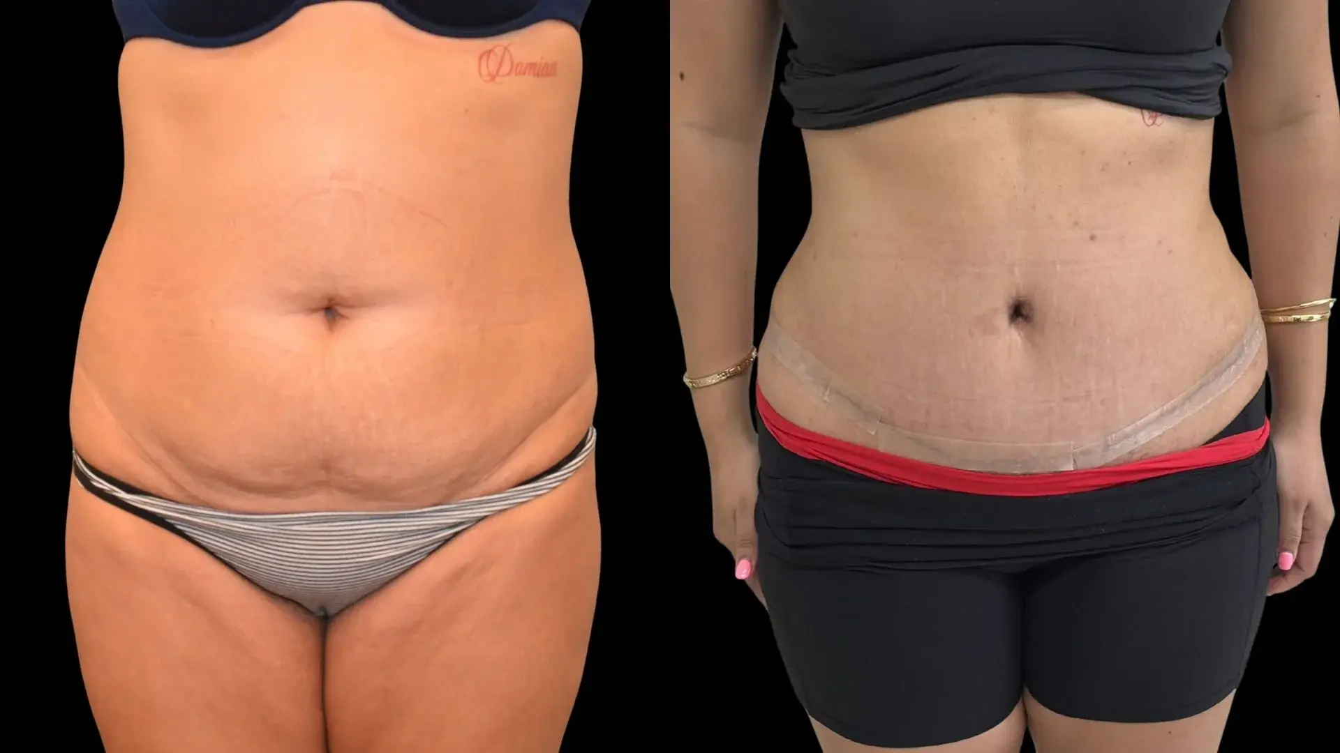 The Plastics Atelier tummy tuck result — Omaha, NE