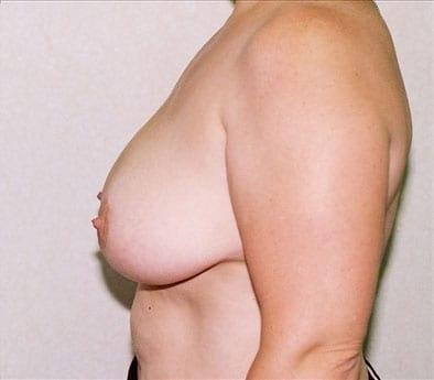 Robert Wald, MD breast reduction after — Fullerton, CA