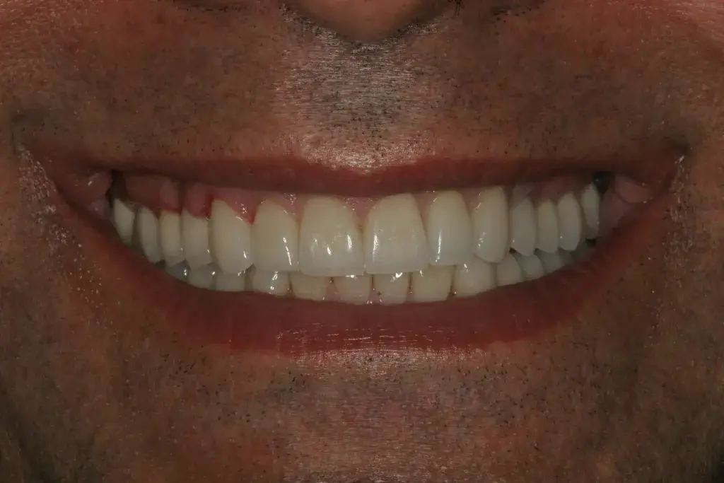 Lasting Smiles Dental Implant Center smile makeover after — Irvine, CA