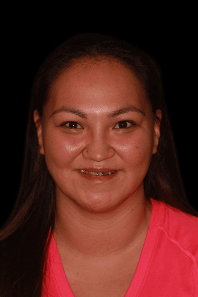 Dental Implants before at Lasting Smiles Dental Implant Center in Irvine, CA
