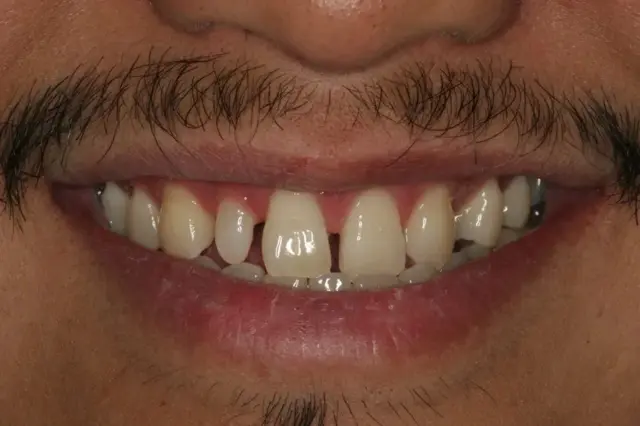 Dental Veneers before at Lasting Smiles Dental Implant Center in Irvine, CA
