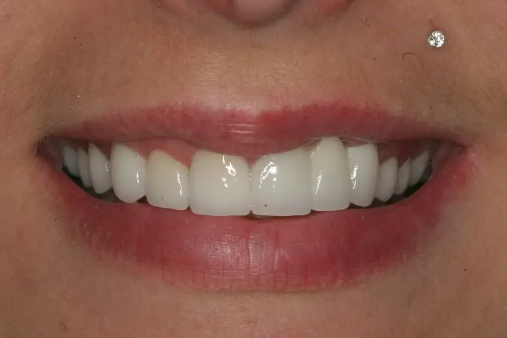 Lasting Smiles Dental Implant Center veneers after — Irvine, CA