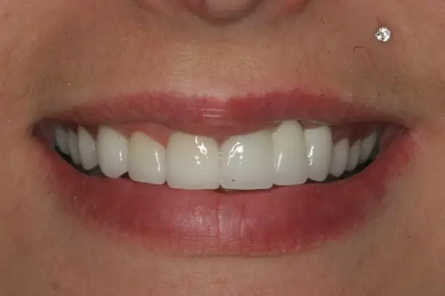Dental Veneers after at Lasting Smiles Dental Implant Center in Irvine, CA