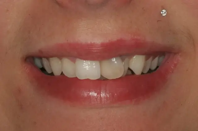 Dental Veneers before at Lasting Smiles Dental Implant Center in Irvine, CA