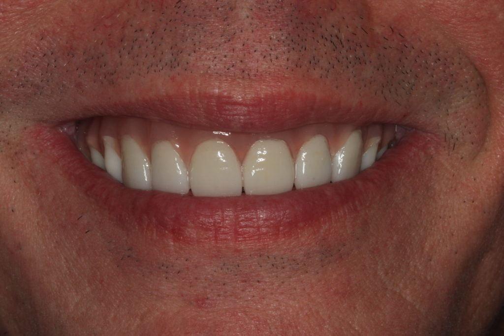 Lasting Smiles Dental Implant Center smile makeover after — Irvine, CA