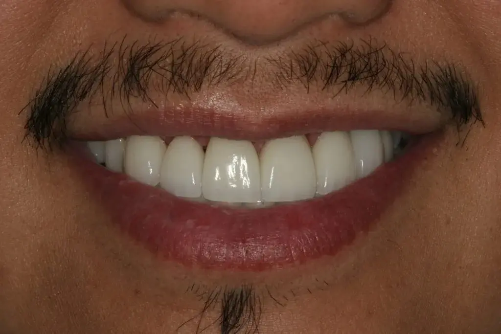 Lasting Smiles Dental Implant Center veneers after — Irvine, CA