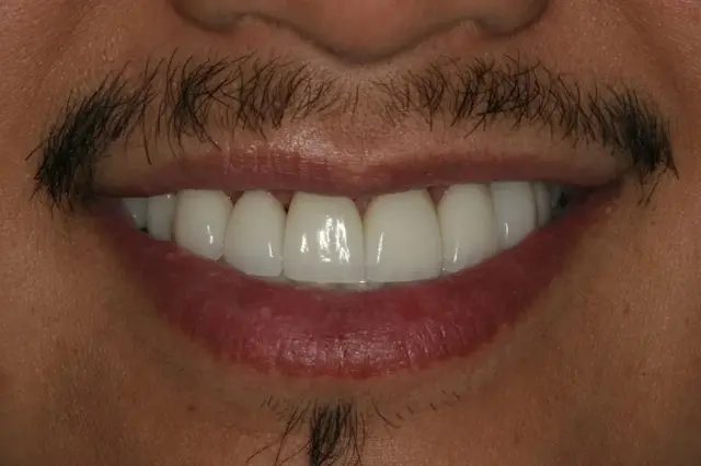 Dental Veneers after at Lasting Smiles Dental Implant Center in Irvine, CA