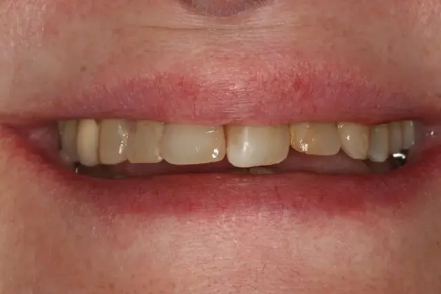 Dental Veneers before at Lasting Smiles Dental Implant Center in Irvine, CA