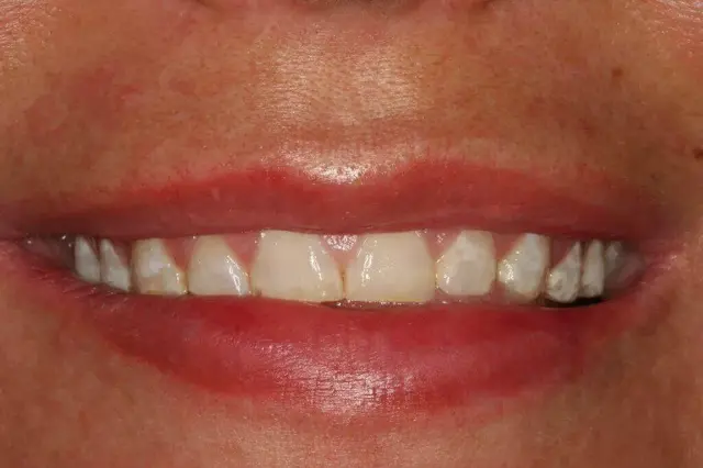 Dental Veneers before at Lasting Smiles Dental Implant Center in Irvine, CA