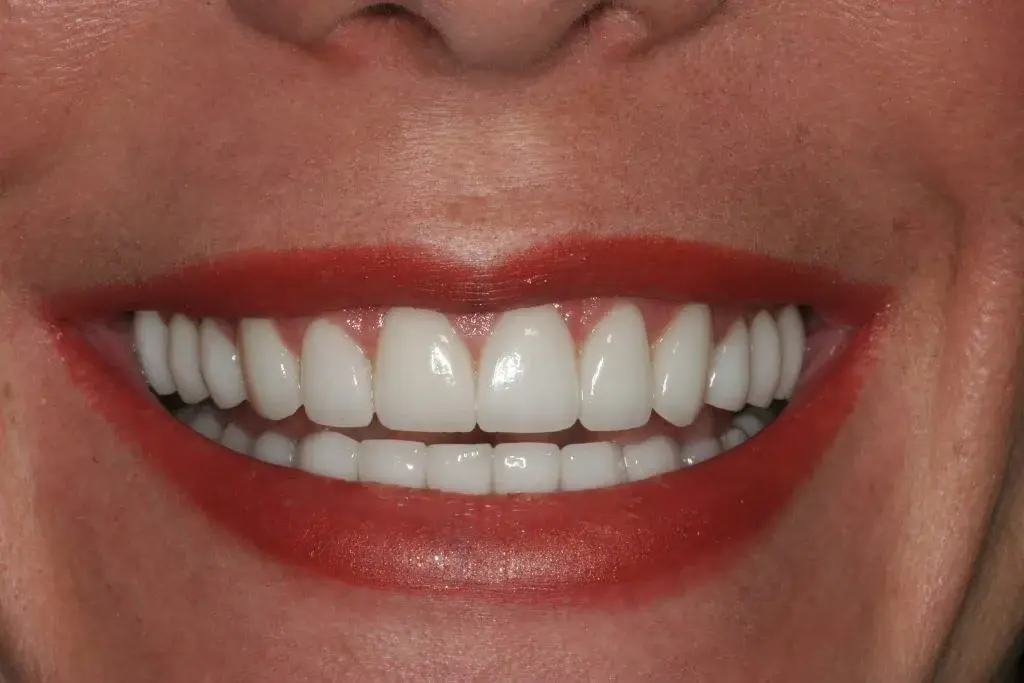 Lasting Smiles Dental Implant Center veneers after — Irvine, CA