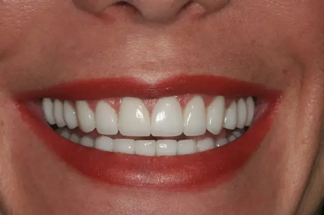 Dental Veneers after at Lasting Smiles Dental Implant Center in Irvine, CA