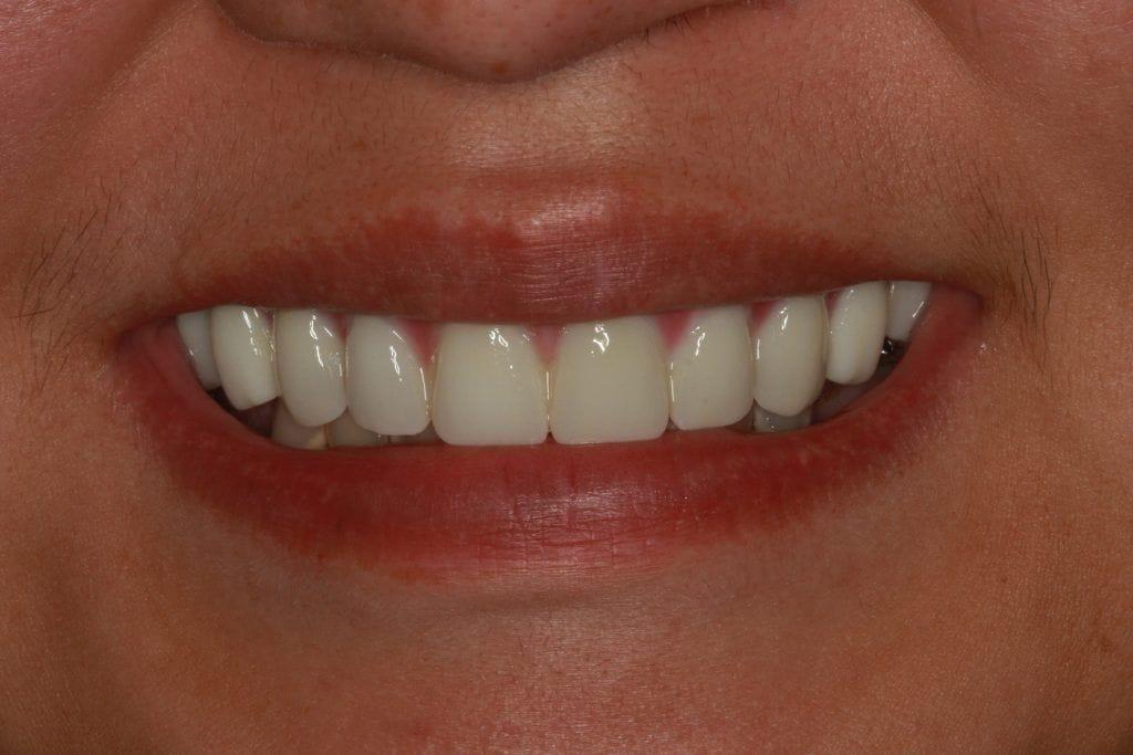 Lasting Smiles Dental Implant Center dental implants after — Irvine, CA