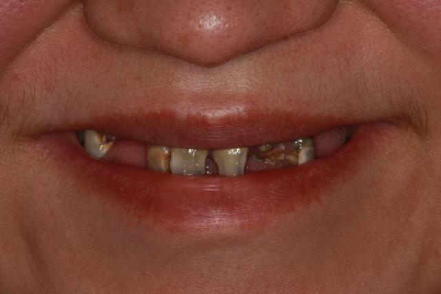 Dental Implants before at Lasting Smiles Dental Implant Center in Irvine, CA