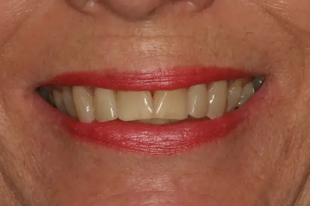 Dental Veneers before at Lasting Smiles Dental Implant Center in Irvine, CA