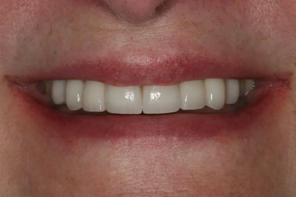 Lasting Smiles Dental Implant Center veneers after — Irvine, CA