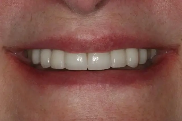 Dental Veneers after at Lasting Smiles Dental Implant Center in Irvine, CA