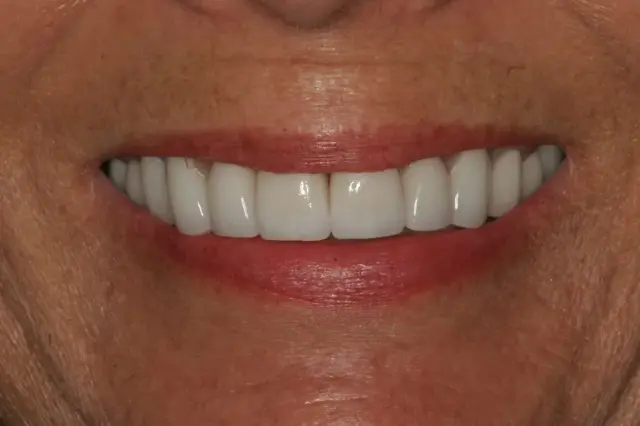 Dental Veneers after at Lasting Smiles Dental Implant Center in Irvine, CA