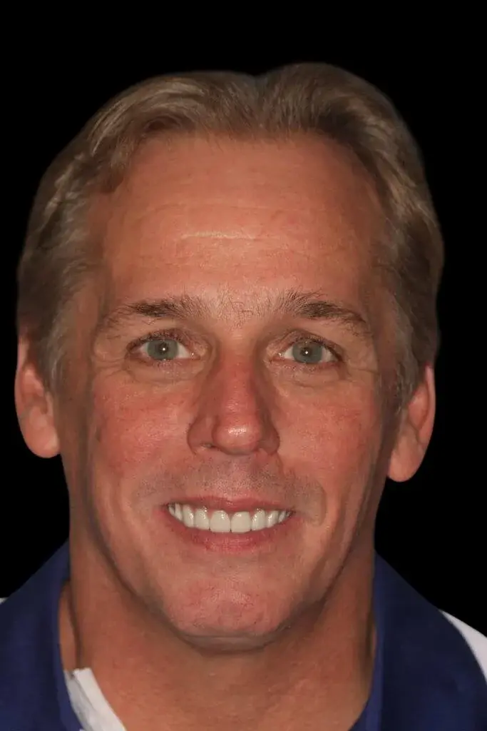Lasting Smiles Dental Implant Center smile makeover after — Irvine, CA