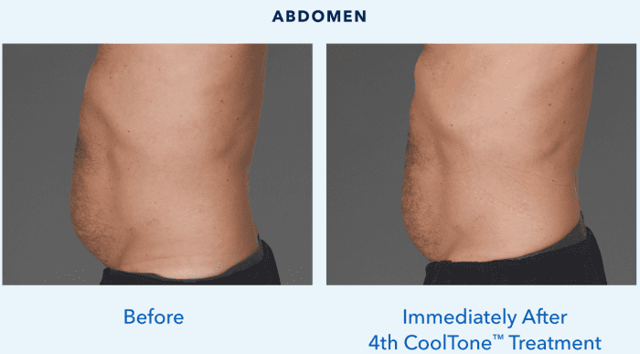 Botox result at Best Impression Med Spa in Blue Bell, PA