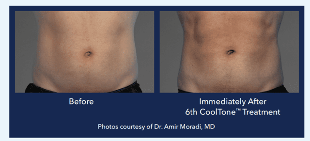 Botox result at Best Impression Med Spa in Blue Bell, PA