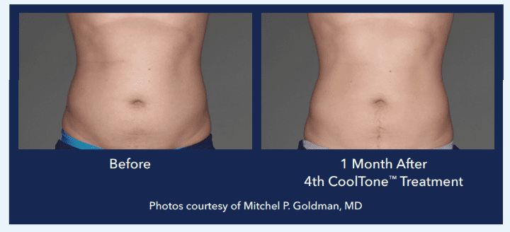 Best Impression Med Spa botox result — Blue Bell, PA