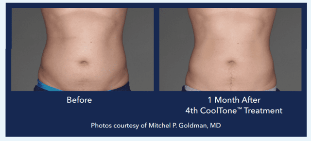 Botox result at Best Impression Med Spa in Blue Bell, PA