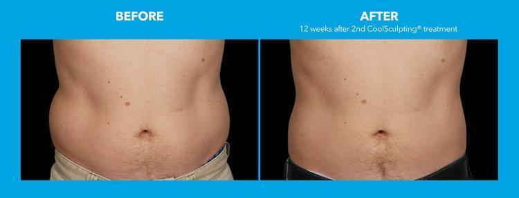 Best Impression Med Spa botox result — Blue Bell, PA