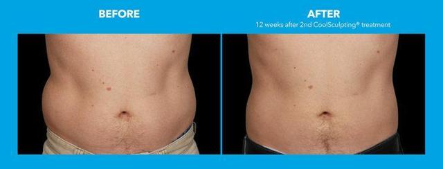 Botox result at Best Impression Med Spa in Blue Bell, PA