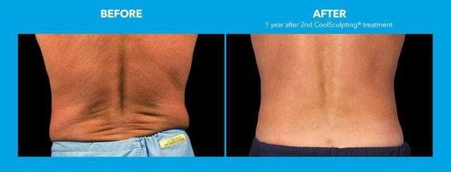 Botox result at Best Impression Med Spa in Blue Bell, PA
