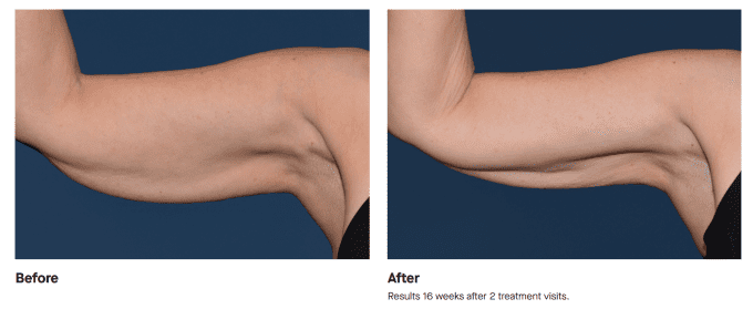Best Impression Med Spa botox result — Blue Bell, PA