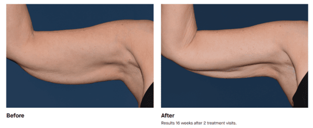 Botox result at Best Impression Med Spa in Blue Bell, PA