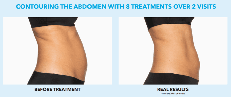 Best Impression Med Spa botox result — Blue Bell, PA