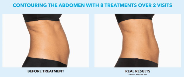 Botox result at Best Impression Med Spa in Blue Bell, PA