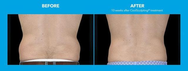 Botox result at Best Impression Med Spa in Blue Bell, PA