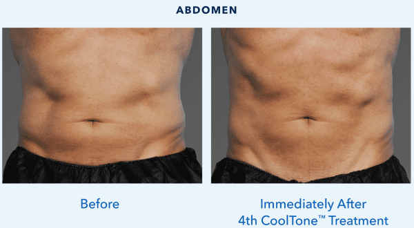 Botox result at Best Impression Med Spa in Blue Bell, PA