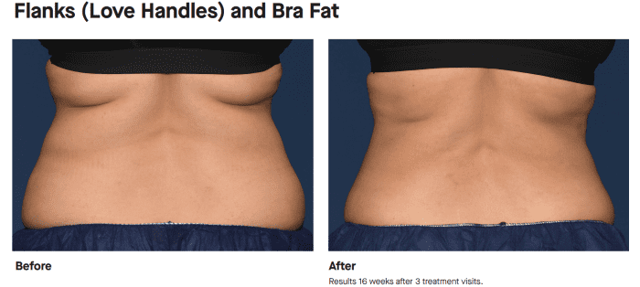 Botox result at Best Impression Med Spa in Blue Bell, PA