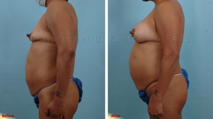 Plastic Surgery Institute of New Mexico breast augmentation result — Albuquerque, NM
