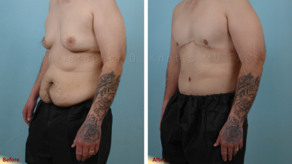 Gynecomastia Surgery result at Plastic Surgery Institute of New Mexico in Albuquerque, NM