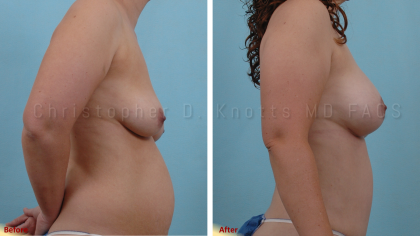 Plastic Surgery Institute of New Mexico breast augmentation result — Albuquerque, NM