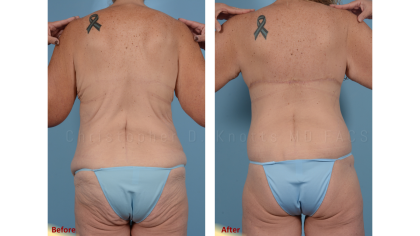 CoolSculpting result at Plastic Surgery Institute of New Mexico in Albuquerque, NM
