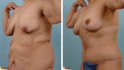 Mommy Makeover result at Plastic Surgery Institute of New Mexico in Albuquerque, NM