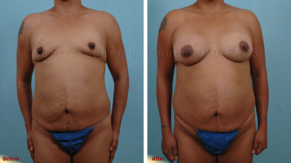 Breast Reduction result at Plastic Surgery Institute of New Mexico in Albuquerque, NM