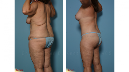 Mini Tummy Tuck result at Plastic Surgery Institute of New Mexico in Albuquerque, NM