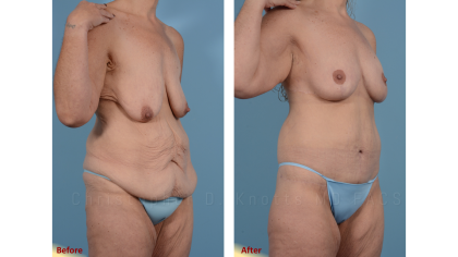 Mini Tummy Tuck result at Plastic Surgery Institute of New Mexico in Albuquerque, NM