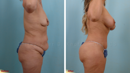 Mommy Makeover result at Plastic Surgery Institute of New Mexico in Albuquerque, NM