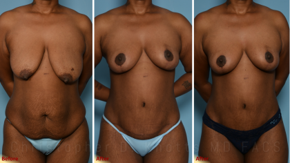 Breast Lift result at Plastic Surgery Institute of New Mexico in Albuquerque, NM